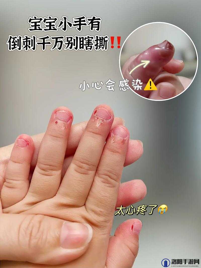 宝宝手指痛为何仅三根手指如此异常